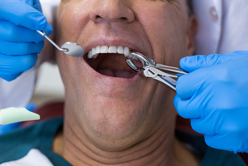Stress-free Dental Extractions: A Painless Guide