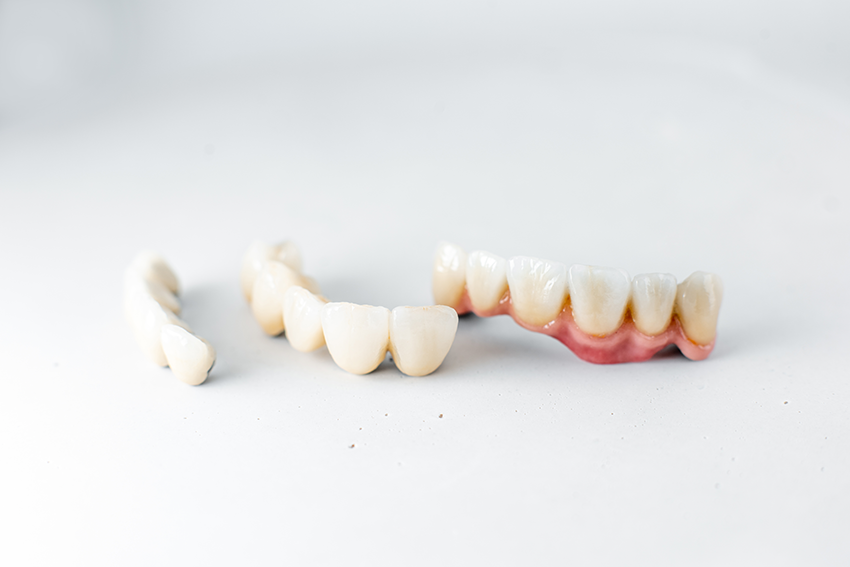 Dental Crowns and Bridges